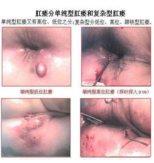 福州医博肛泰肛肠医院预约挂号