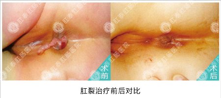 HCPT肛泰方法治肛裂伴肛乳头瘤