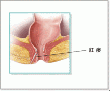 肛瘘示意图