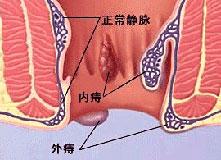 福州医博肛泰肛肠医院预约挂号