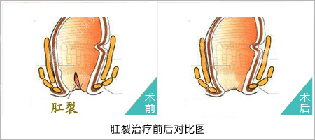 福州医博肛泰肛肠医院预约挂号