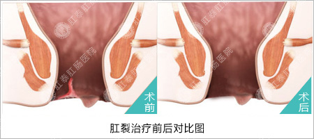 福州医博肛泰肛肠医院预约挂号