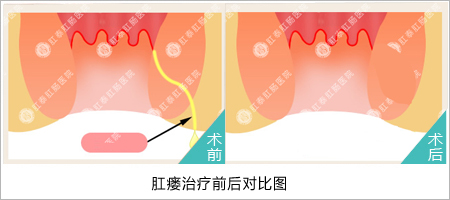 福州医博肛泰肛肠医院预约挂号