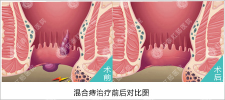 福州医博肛泰肛肠医院预约挂号