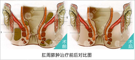 福州医博肛泰肛肠医院预约挂号