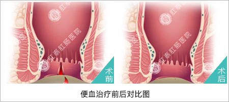 福州医博肛泰肛肠医院预约挂号