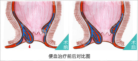 福州医博肛泰肛肠医院预约挂号