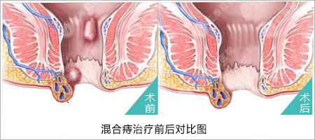 福州医博肛泰肛肠医院预约挂号