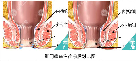 福州医博肛泰肛肠医院预约挂号