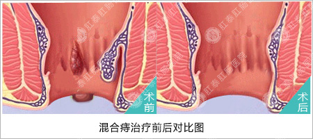 福州医博肛泰肛肠医院预约挂号