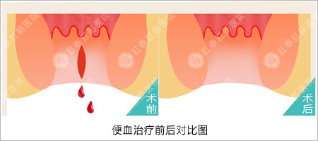 福州医博肛泰肛肠医院预约挂号