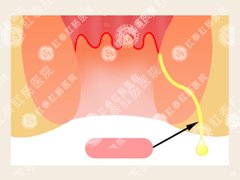 福州医博肛泰肛肠医院预约挂号