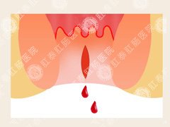 福州医博肛泰肛肠医院预约挂号