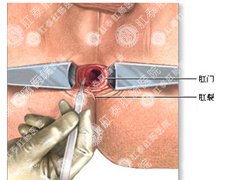 福州医博肛泰肛肠医院预约挂号