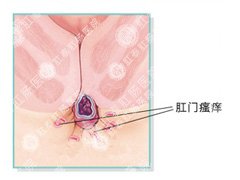 福州医博肛泰肛肠医院预约挂号