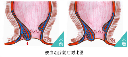 福州医博肛泰肛肠医院预约挂号