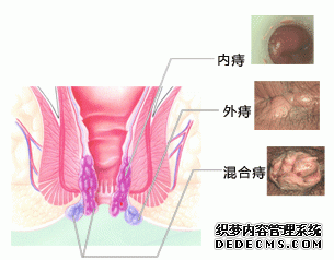 福州哪家医院看痔疮好