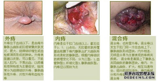 福州痔疮手术费用