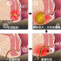 福州哪家肛肠医院治肛瘘好？