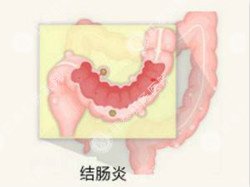 福州肛门疼痛坠胀去哪个医院看好