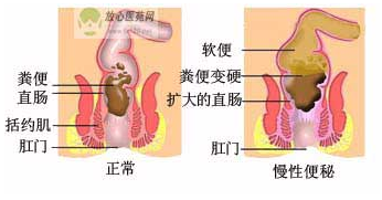 福州便秘了去哪家医院看