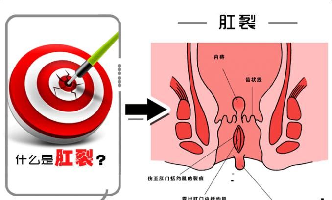 初期肛裂都有哪些症状