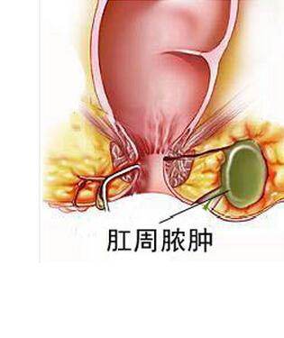 福州治肛周脓肿的专科医院