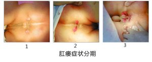福州肛瘘哪里看不错