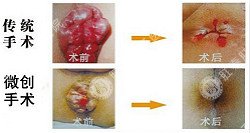 福州医博肛泰肛肠医院预约挂号