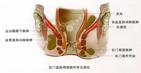 福州屁股红肿饮食注意事项。