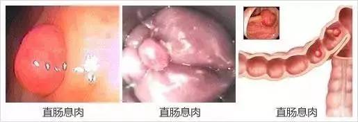直肠息肉