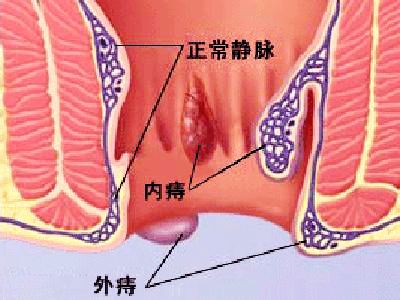 为什么会长混合痔