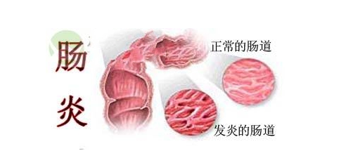 慢性结肠炎患者能不能喝牛奶?